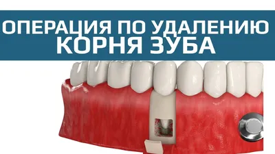 Резекция верхушки корня зуба, цена в Москве в стоматологии Smile-at-Once