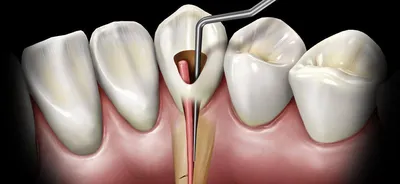 Лечение каналов зуба в Москве, цены на лечение каналов в стоматологии АО  «Медицина» (клиника академика Ройтберга)