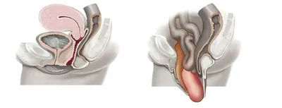 PDF) Pathogenesis of vaginal prolapse with the formation of rectocele: a  review