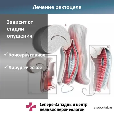 Ректоцеле: симптомы, диагностика, лечение, операция