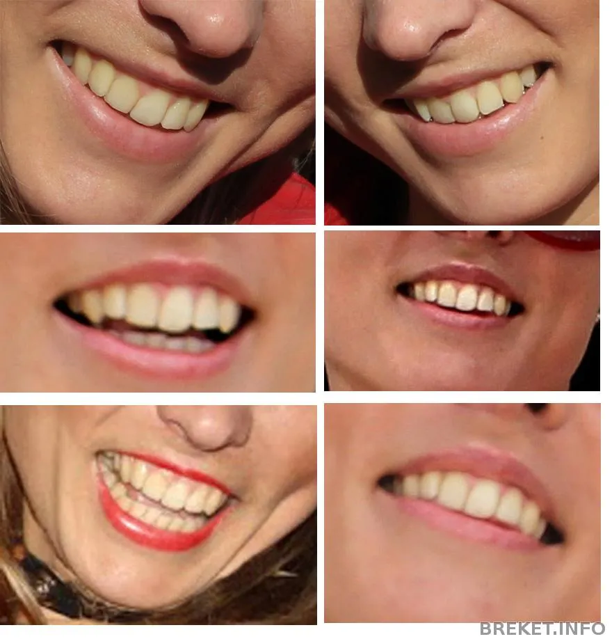 Коррекция smile clinicaspectr ru. Десневая улыбка коррекция брекетами. Диастема до и после брекетов.