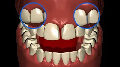Сепарация зубов до и после фото