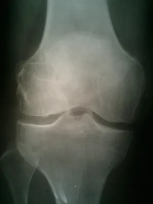 КСС. Коленный сустав. Эффективность рентгенологических и ультразвуковых  методов диагностики дегенеративных заболеваний суставов (на примере коленного  сустава). + | Портал радиологов