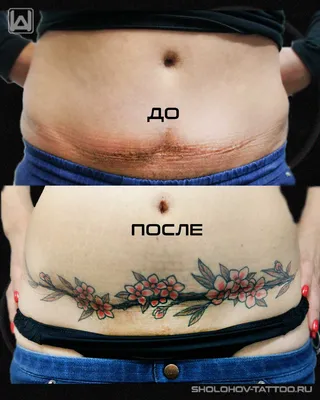 Перекрытие шрамов/ожогов/растяжек татуировкой в Санкт Петербурге