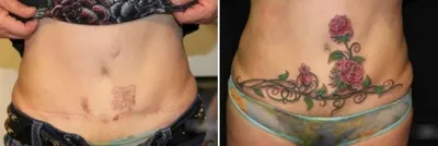 Татуировки, маскирующие дефекты внешности - ЯПлакалъ