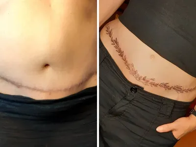 16 татуировок, которые помогли своим обладателям забыть о стеснении из-за  шрамов на теле