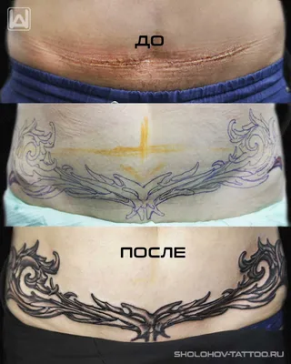 Перекрытие шрамов/ожогов/растяжек татуировкой в Санкт Петербурге