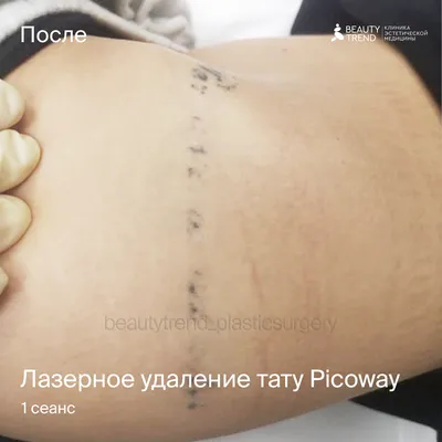Удаление татуировок на пикосекундном лазере Picoway в Москве | Цены, отзывы  на процедуру в клинике Beauty Trend