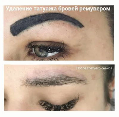 Каким способом удалить татуаж? | Viktoria Beauty Club