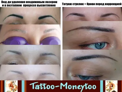 Удаление татуажа и татуировок лазером в Донецке. - тату салон  \"Tattoo-Moneytoo\" в Донецке