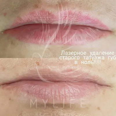 Удаление татуажа фото | MyLife Beauty Studio