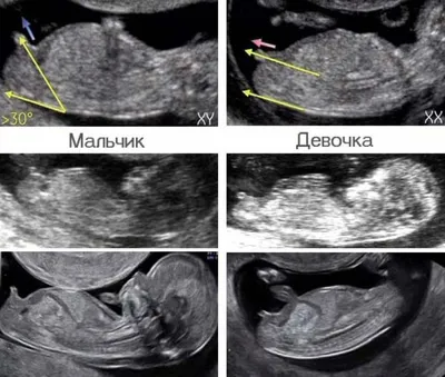 3D узи 11 недель — 14 ответов | форум Babyblog