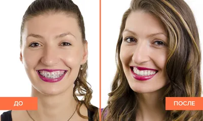 Снятие брекетов с зубов — как снимают, что носят после снятия, можно ли  снять раньше в статье Startsmile