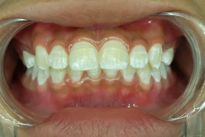 Желтеют ли зубы от брекетов? | Dentell