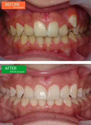 Идеальное ортодонтическое лечение - это брекеты без удаления зубов!  Обращайтесь к ортодонтам вовремя!