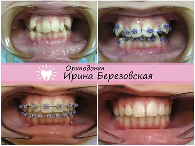 Лечение брекетами До и После | Студия улыбок Ирины Березовской