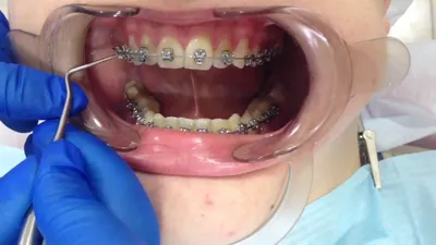 Снятие брекетов и чистка зубов | стоматология Самара | брекеты влог braces  off - YouTube