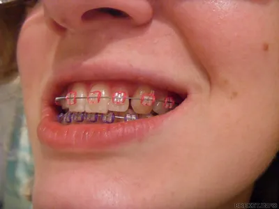Почему болят зубы после установки брекетов? Что делать, чтобы не болели зубы  в брекетах.