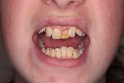 Ортодонтия. Результат за 2 года. До и после | Пикабу