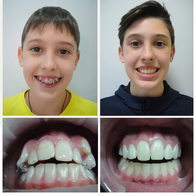 Исправление зубов брекетами - Стоматология \"Скаковский\"