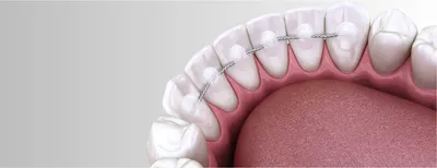 Ретейнеры после брекетов: что это такое и сколько их носят? Стоматология  Dental Way в Москве и Московской области | Dental Way