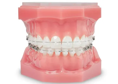Портятся ли зубы после брекетов, гигиена и профилактика