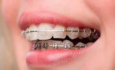Портятся ли зубы от брекетов: какие могут быть осложнения - энциклопедия  Ochkov.net
