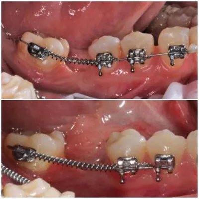Дистализация 7-го зуба или как подвинуть зуб, чтобы получить место для  имплантата? - блог стоматолога TopSmile
