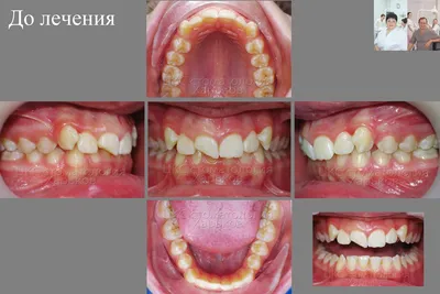 Лечение брекетами зубов с дефектами в виде сколов