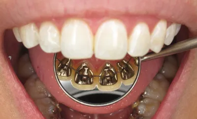 Разъезжаются зубы после снятия брекетов