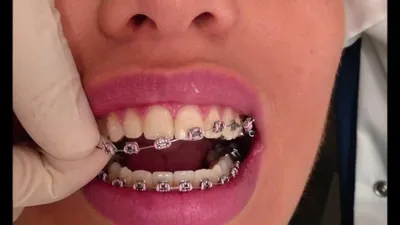 Снятие брекетов с зубов: когда и как снимают брекеты - Underson Clinic