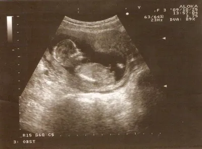 Фото УЗИ 15 недель беременности / Размер плода при УЗИ на 15 неделе, видео