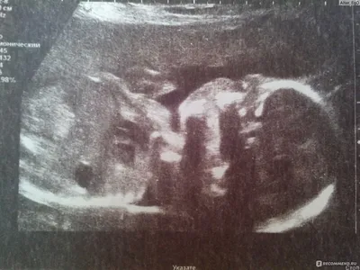Фото УЗИ при беременности - «Как интересно наблюдать за ростом и развитием  маленькой жизни внутри себя. А уж любимый человек то в каком восторге!  (фото узи и 3D снимков)» | отзывы