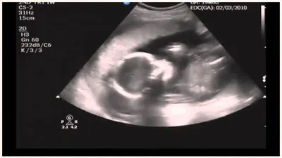 УЗИ беременности на 19 неделе, нормы, фото, видео