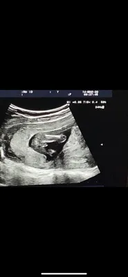 Пол ребёнка на 16 недели. Мальчик - Вопрос гинекологу - 03 Онлайн