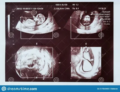 ребенок на УЗИ 20 недель. коллаж под разными углами. Стоковое Изображение -  изображение насчитывающей ðµð½ð½oð³o, ñ‹ñˆ: 217563405