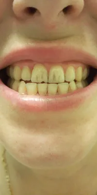 Почернение передних зубов - Вопрос стоматологу - 03 Онлайн