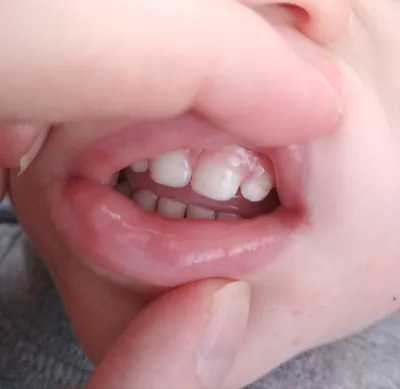 Налет и ямки в зубе - Вопрос стоматологу - 03 Онлайн