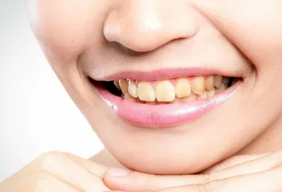 Белые пятна на зубах или черное на зубах? Что делать, если зубы потемнели  или чернеют?