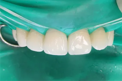 Белые пятна и меловые точки на зубах – что это значит и от чего появляется  – причины: что делать, если у взрослого на постоянных передних резцах  прозрачные полоски