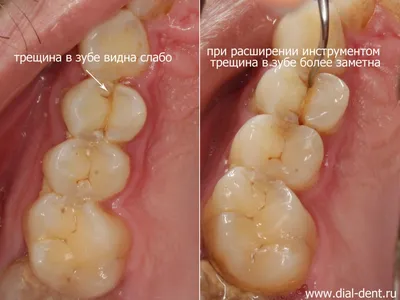 Трещины на зубах, почему появляются, как лечить, трещина или перелом.