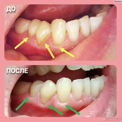 Очистка зубов методом AIR FLOW - «Чистка в стоматологии \"Панацея плюс\"  (Саратов). Внутри налёт на зубах как был, так и остался. Зато быстро.» |  отзывы
