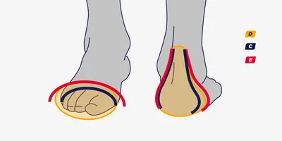 Вальгусная деформация первого пальца стопы (Hallux valgus): самые частые  структурные изменения плюсневого сустава большого пальца. - Institut Català  del Peu