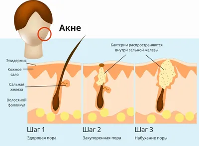 Шишка на пятке сзади фото