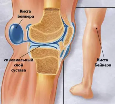 Шишка под коленом: отчего возникает и как лечить кисту Бейкера?