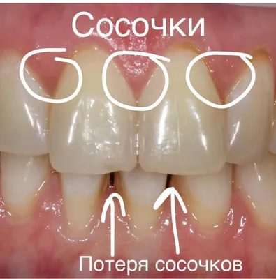 Десневые сосочки. Или зачем нужна десневая пластика? - блог стоматолога  TopSmile