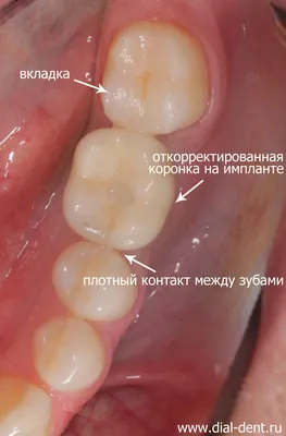 Замена расколовшейся пломбы и коррекция коронки на импланте