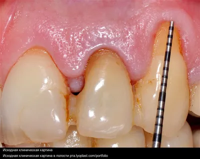 ⚡️ Рецессия десны по старой цене руб.⚡️ | Стоматология Ⓜ️ Митино