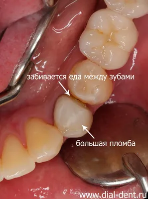 Керамическая коронка вместо пломбы, чтобы не застревала пища между зубами