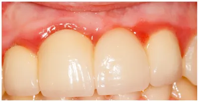 Осложнения после протезирования - на портале 100zubov.ru